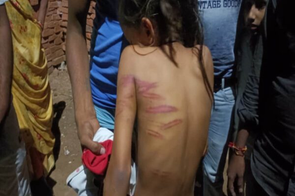 प्रिंसिपल ने 5वीं की छात्रा को बाल पकड़कर खींचा, फिर डंडे से मारा; पीठ पर पड़ गए निशान